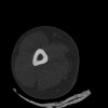SPORK, NICO - 22.03.1976 - 02.08.2022 - CT obere Extremität - 17:51:17
